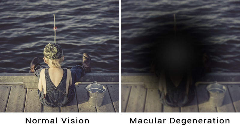 Keeping Sight of Age-Related Macular Degeneration
