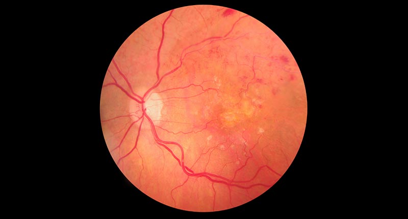 8 Eye Conditions Retinal Imaging Can Diagnose and Monitor