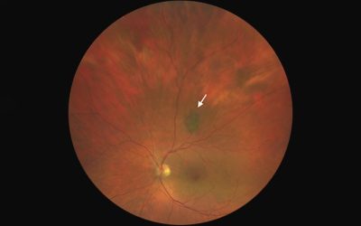 When a Freckle in the Eye Isn’t Just a Freckle